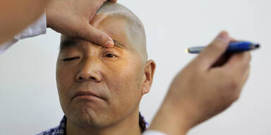 Mann bekommt neuen Kopf aus 3D-Drucker