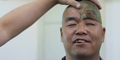 Mann bekommt neuen Kopf aus 3D-Drucker