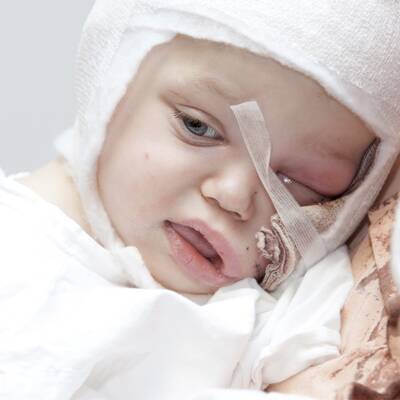 Benet (2) von Hund gebissen