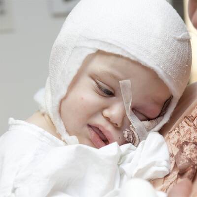 Benet (2) von Hund gebissen