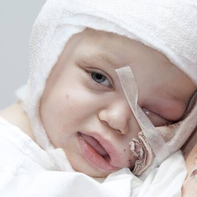 Benet (2) von Hund gebissen