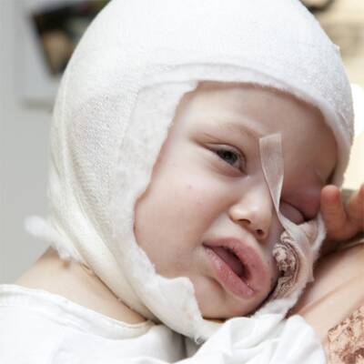 Benet (2) von Hund gebissen