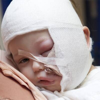 Benet (2) von Hund gebissen