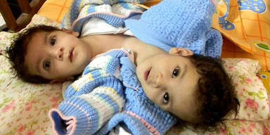 Siam-Zwilling nach Trennung gestorben