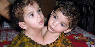 Siam-Zwilling nach Trennung gestorben