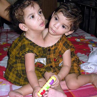 Stuti Aradhna Siamesische Zwillinge