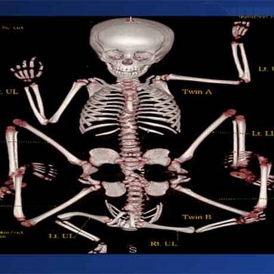 CT der kleinen Lakshmi