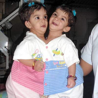 Stuti Aradhna Siamesische Zwillinge