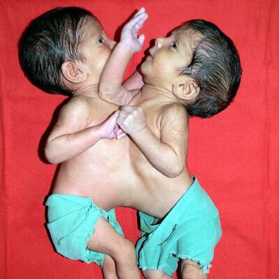 Stuti Aradhna Siamesische Zwillinge