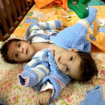 Stuti Aradhna Siamesische Zwillinge