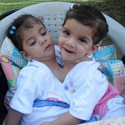 Stuti Aradhna Siamesische Zwillinge