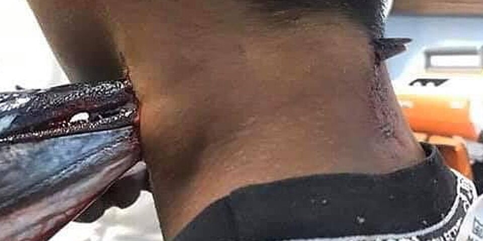 Hornhecht bohrt sich durch Hals eines 16-Jährigen