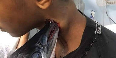 Hornhecht bohrt sich durch Hals eines 16-J&auml;hrigen