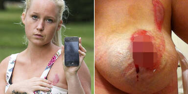 iPhone brennt Frau Loch in Busen