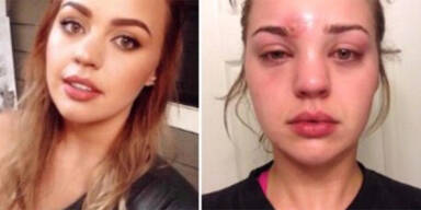 Pickel ausgedr&uuml;ckt: Katie w&auml;re beinahe gestorben