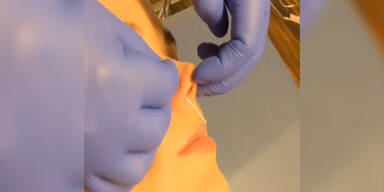 Katy Perry: Nadel-Folter für die Schönheit!