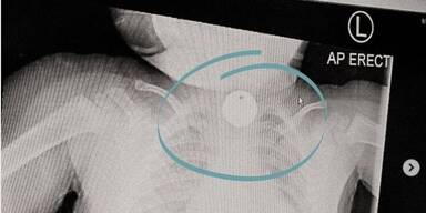 Baby verschluckt Alltagsgegenstand: Sanit&auml;terin warnt