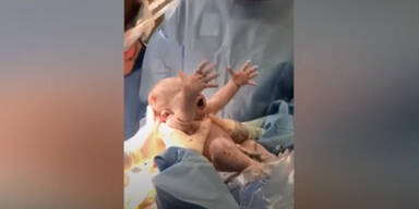 Frau zieht sich Baby selbst aus Bauch