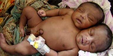 Baby mit zwei Köpfen gestorben