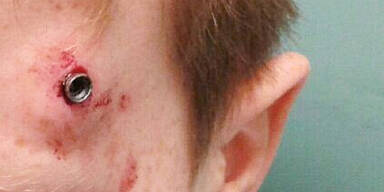 Bub (11) in den Kopf geschossen