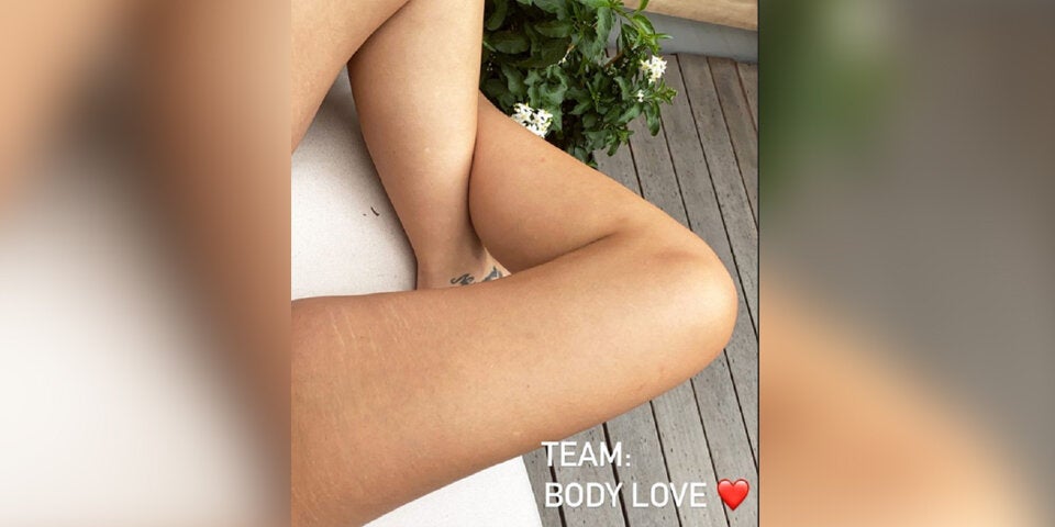 Lena Meyer-Landrut steht zu ihren Dehnungsstreifen