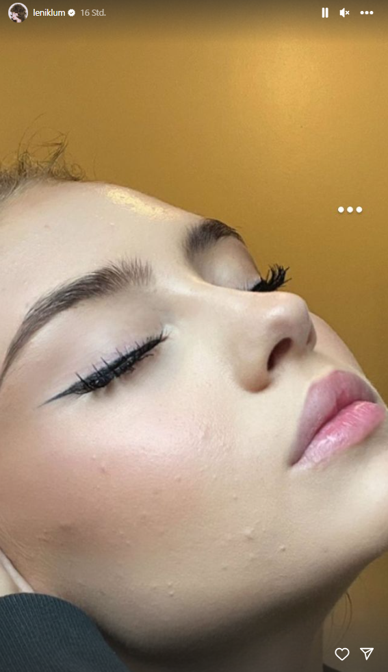 Leni Klum zeigt ihre Akne – und setzt damit ein wichtiges Zeichen