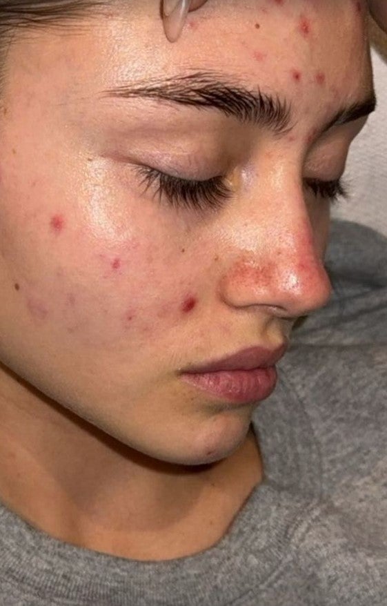 Leni Klum zeigt ihre unreine Haut