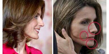 Kinn & Lachfalten - Letizia hat ein neues Gesicht