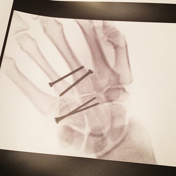 Schock: Ligety brach sich die Hand