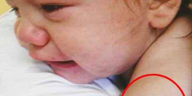 Luca von blauen Flecken übersät