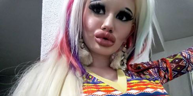 Frau l&auml;sst sich Lippen 15 mal aufspritzen