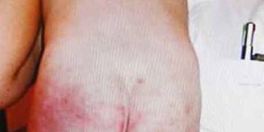 Luca von blauen Flecken übersät