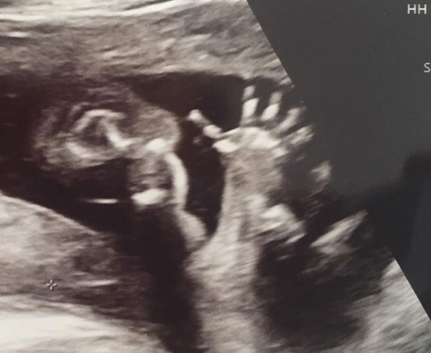 Christine Reiler zeigt Ultraschallbild