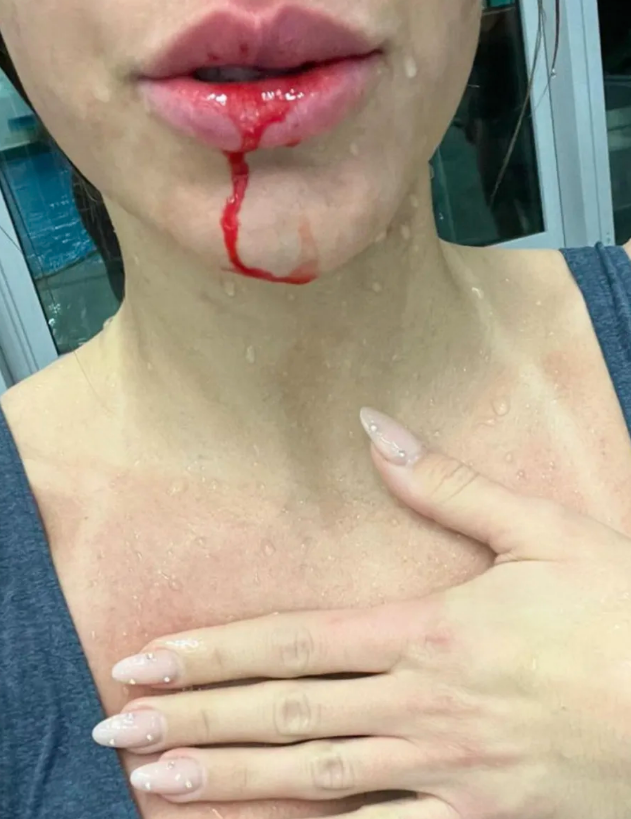 Schockierend: Österreichischer TV-Star stirbt fast bei Brust-OP