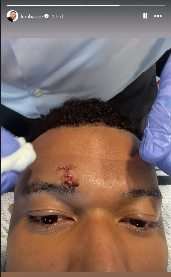 Blut-Schock um Mbappé – Real bangt vor Bayern-Kracher