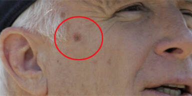 Hat McCain Hautkrebs?