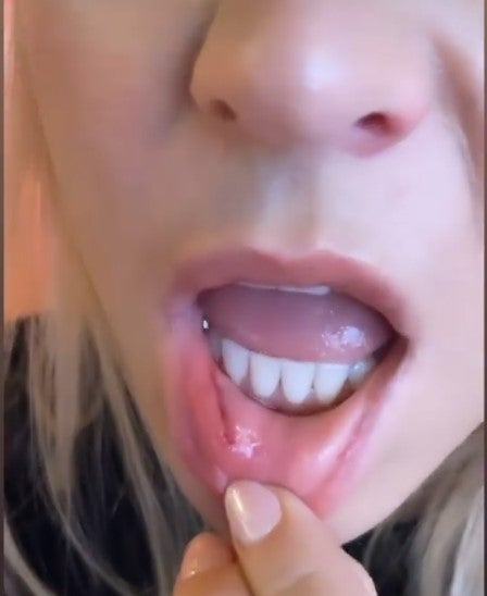 'Let's Dance'-Unfall: Austro-Star blutet aus dem Mund