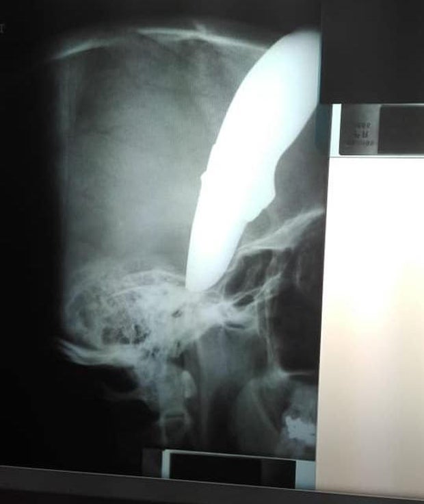 Südafrikaner (34) überlebte mit Messer im Kopf