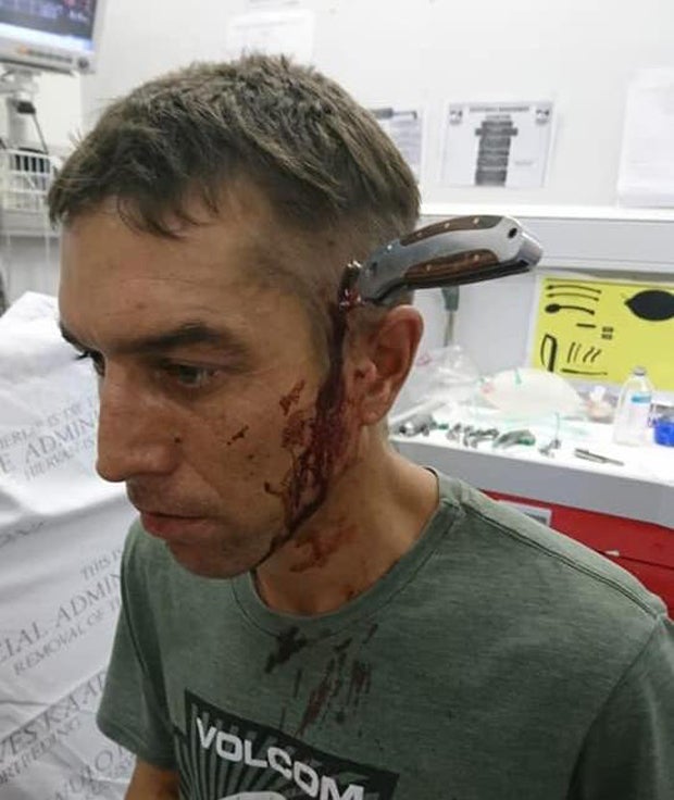 Südafrikaner (34) überlebte mit Messer im Kopf