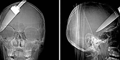 Diebe rammten Teenager Messer in den Kopf