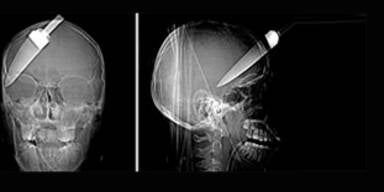 Diebe rammten Teenager Messer in den Kopf