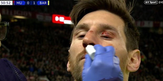 Barca gewinnt 1:0, Blutspiel für Messi