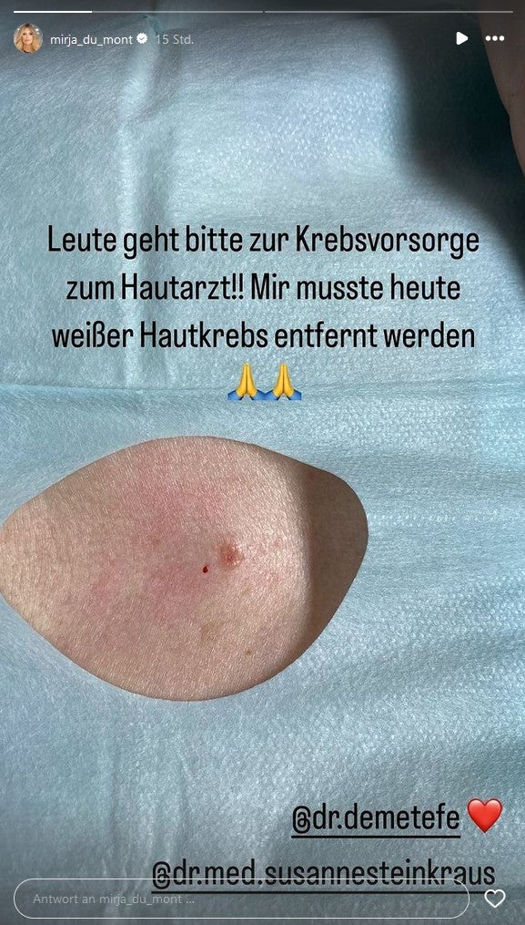 Mirja du Mont zeigt, wie unauffällig weißer Hautkrebs aussehen kann