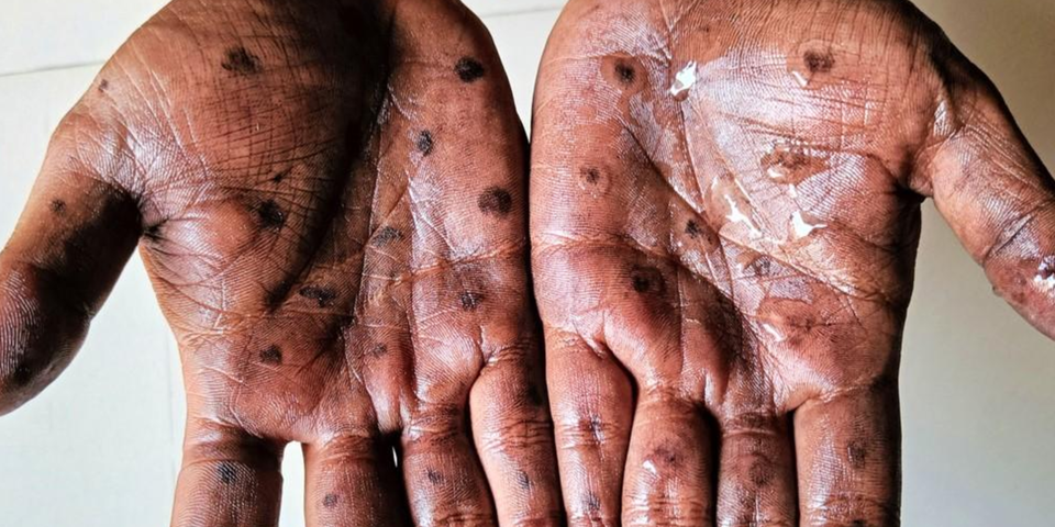 Experten warnen: DIESES Virus kann die nächste Pandemie auslösen