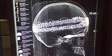 Deutsche Mumie hat ein Plastikskelett