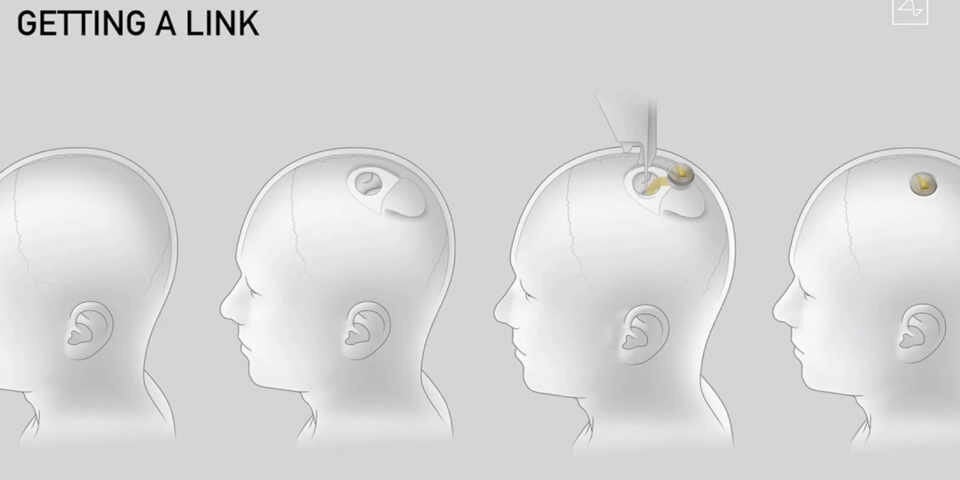 Musk will Gelähmte wieder gehen lassen