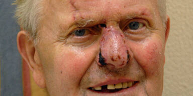 Ärzte nähten Oberösterreicher abgerissene Nase wieder an