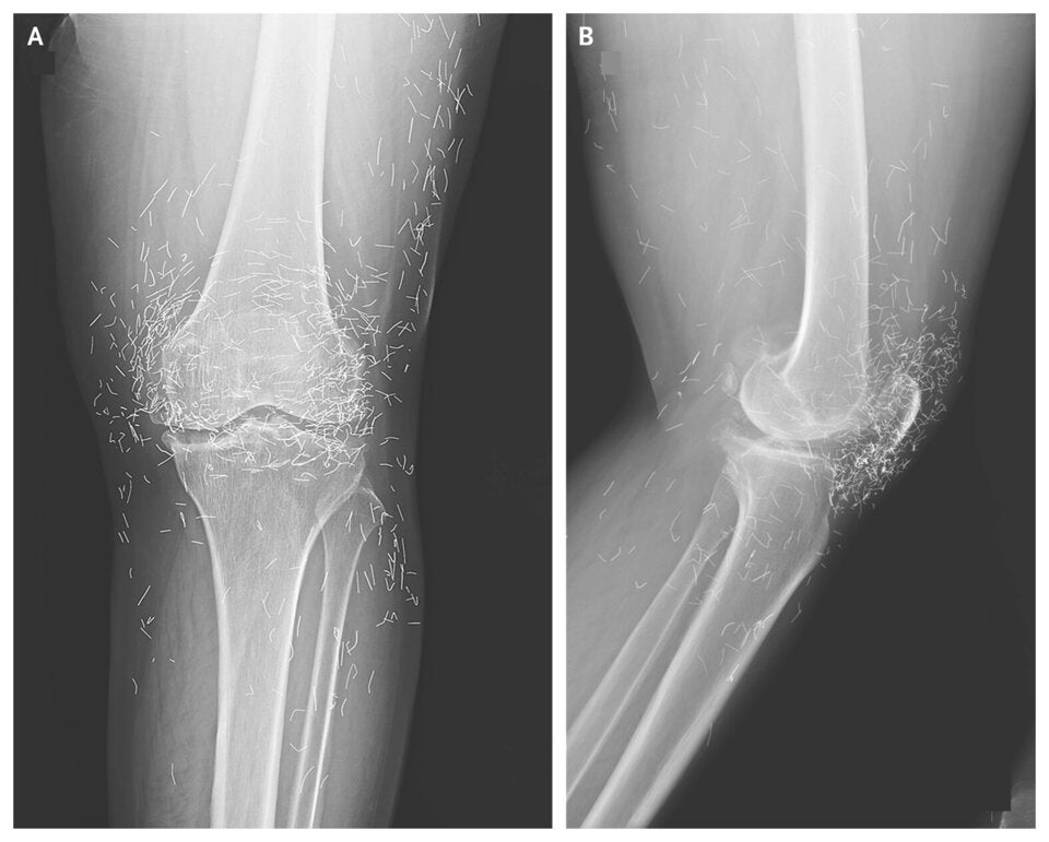 Röntgenaufnahme eines Knies mit auffälligen Fremdkörpern im Gewebe – Ärzte fanden Hunderte winzige Goldfäden. 