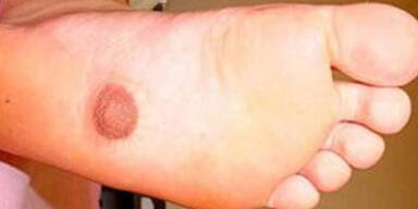 Frau w&auml;chst dritter Nippel am Fu&szlig;