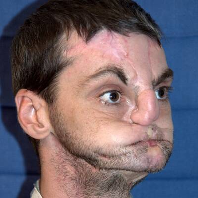 Weltweit umfangreichste Gesichtstransplantation